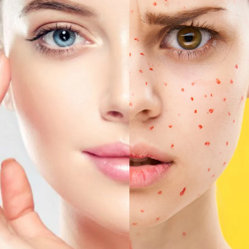 problème avec acné? Laver le visage avec de l'eau d'hydrogène est efficace pour améliorer la peau 
